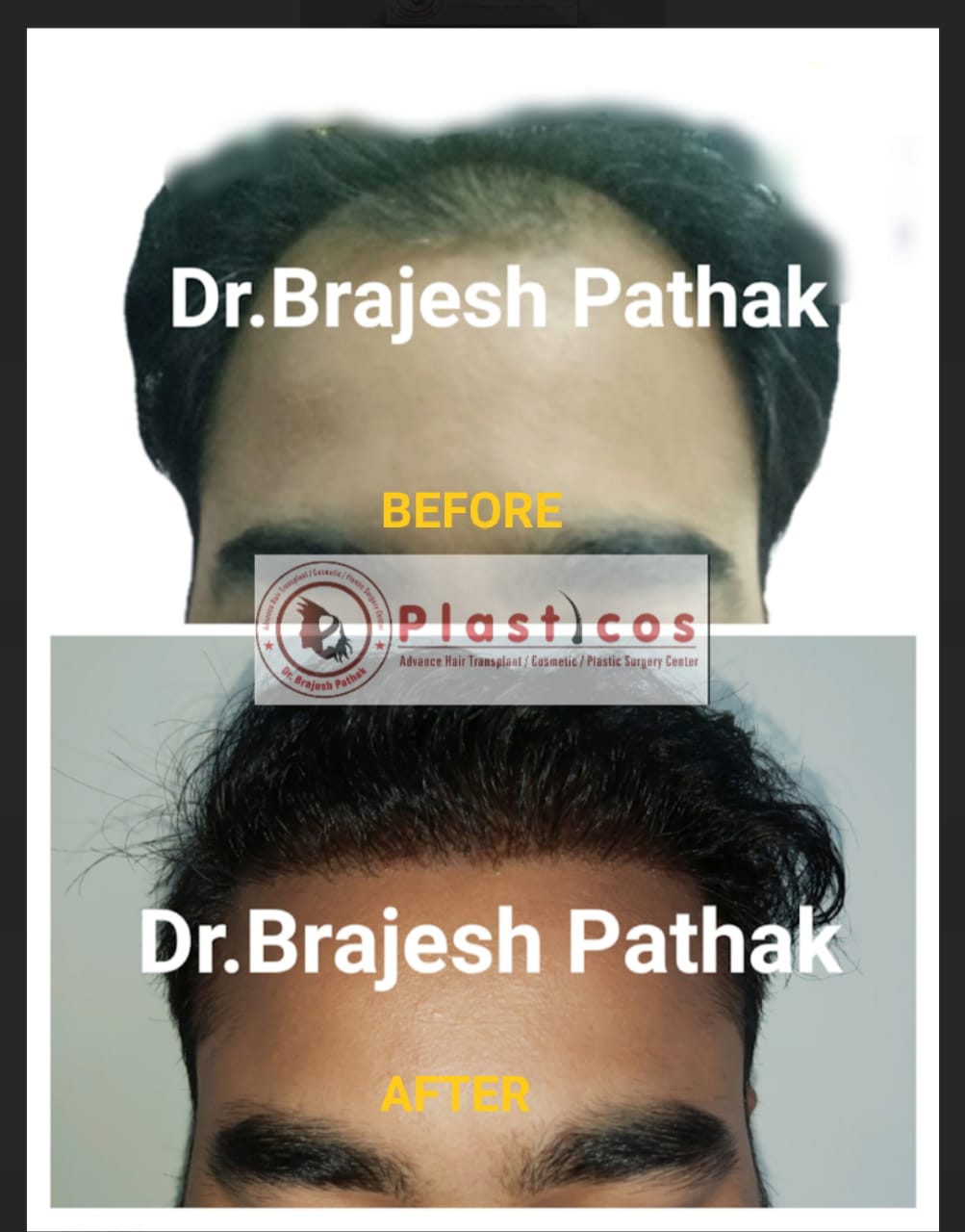GALLERY – Dr. Brajesh Pathak | PLASTICOS – Best Hair Treatment | Plastic  Surgeon Clinic | Best Cosmetic Surgeon in Lucknow