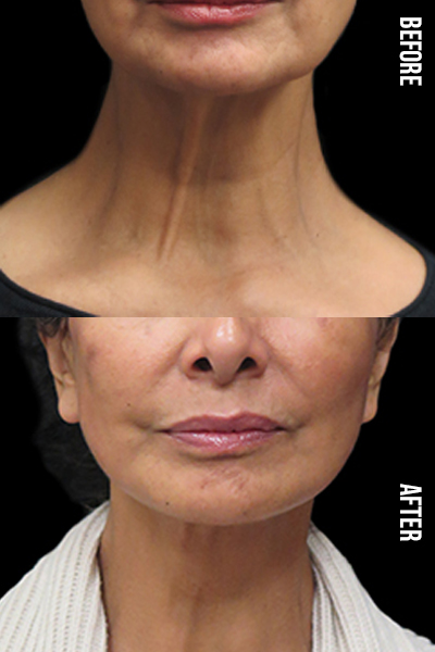 Plastysmaplsty surgery