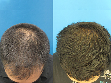 Fut hair transplant