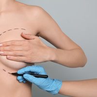 Doctor drawing marks on female breast for cosmetic surgery operation against color background